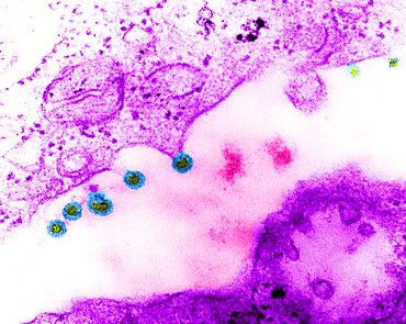 Rubella Virus, German Measles, TEM