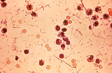 Shigellosis, Bacterial Dysentery, LM