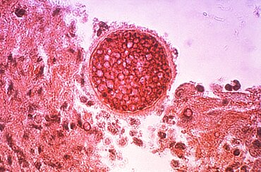 Coccidioidomycosis, Valley Fever, LM