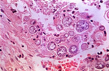 Coccidioidomycosis, Valley Fever, LM