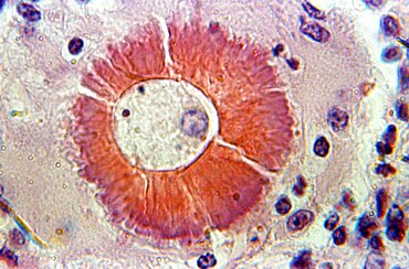 Coccidioidomycosis, Valley Fever, LM