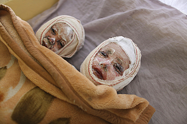 burn victims of a IED attack in Afghanistan