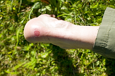 A blister on the heel of a mountaineer