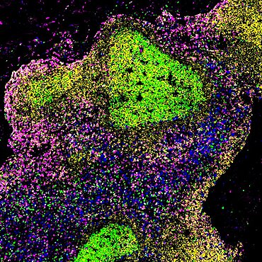 Lymph node of person with untreated hiv