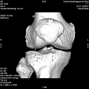 Knee Osteoarthritis, 3D Scan