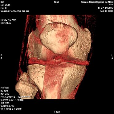 Knee, 3D Scan