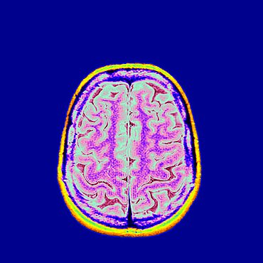 MRI cross section of human head