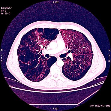 Lung Scan for Pulmonary Emphysema