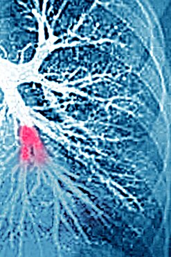 Pulmonary embolism