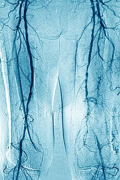 Obliterating arterial disease of the lower limbs