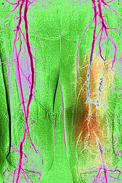 Obliterating arterial disease of the lower limbs