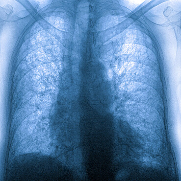 Pulmonary fibrosis (lesion of the lungs characterized by the presence of excess fibrous connective tissue), chest x-ray.