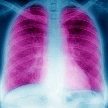 Pneumonia with radiological appearance in frosted glass