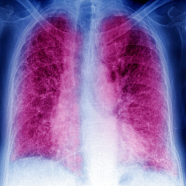 Pulmonary fibrosis (lesion of the lungs characterized by the presence of excess fibrous connective tissue), chest x-ray.