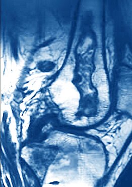 Osteonecrosis Of The Knee Rmn