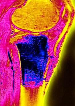 Osteosarcoma, MRI