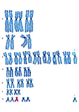 Downs Syndrome Karyotype