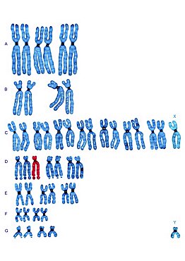 Trisomy 13