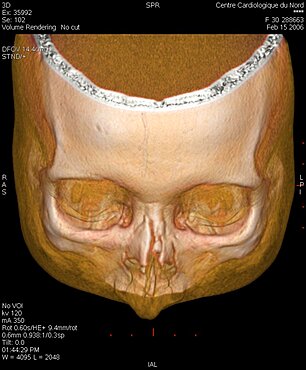 Fractured Nose, 3D Scan