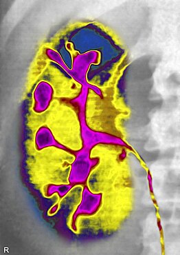 Polycystic Kidney Disease, X-Ray