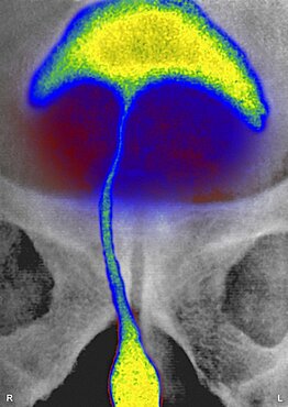 Prostatic Adenoma, X-Ray