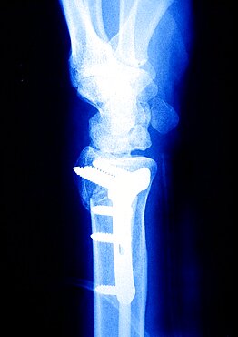 Arm Osteosynthesis, X-Ray