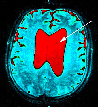 Hydrocephalus, Scan