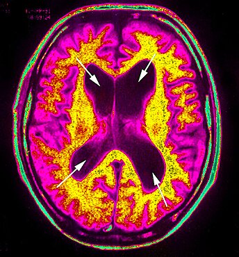 Hydrocephalus, Scan