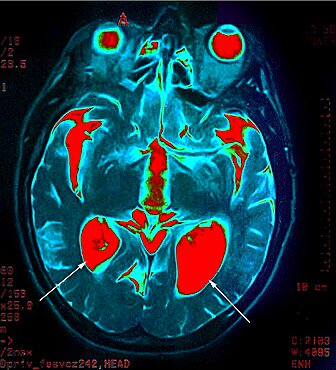 Hydrocephalus, Scan