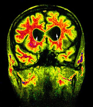 Hydrocephalus, Scan