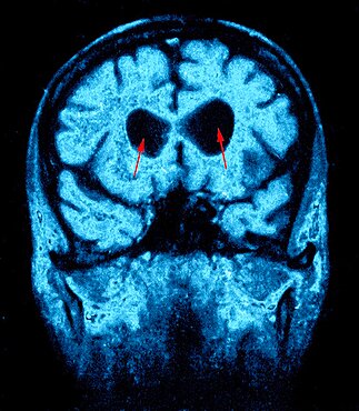 Hydrocephalus, Scan