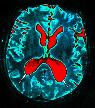 Hydrocephalus, Scan