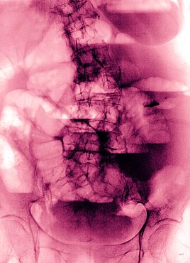 Impaction Of The Bowel, X-Ray