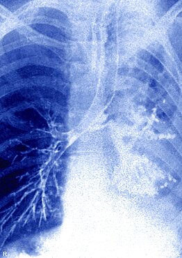 Bronchial Rupture, X-Ray