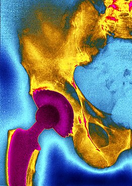 Hip Prosthesis,  X-Ray