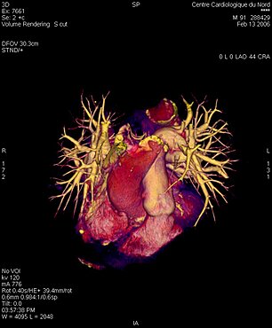 Pulmonary Artery, 3D Scan