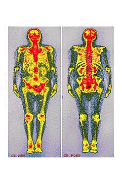 Obesity, Scintigraphy