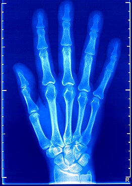 Hand, X-Ray