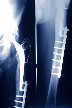 Hip Prosthesis,  X-Ray