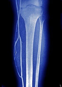 Lower Limb, Angiography