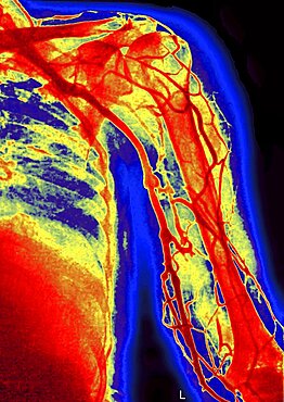 Upper Limb, Angiography