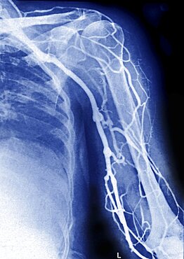 Upper Limb, Angiography