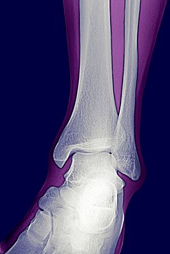 Ankle, X-Ray