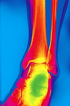 Ankle, X-Ray