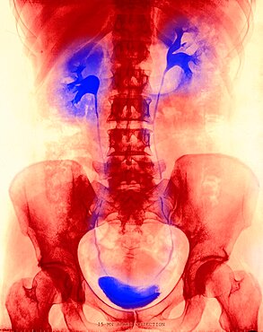 Urinary System, X-Ray Finding