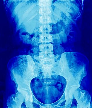 Pelvis, X-Ray