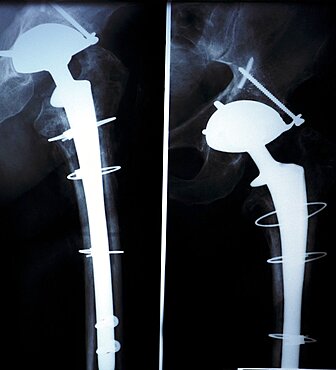 Hip Prosthesis, X-Ray