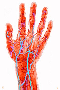 Hand, Arteriography