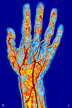 Hand, Arteriography