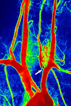 Stenosis Of Vertebral Artery